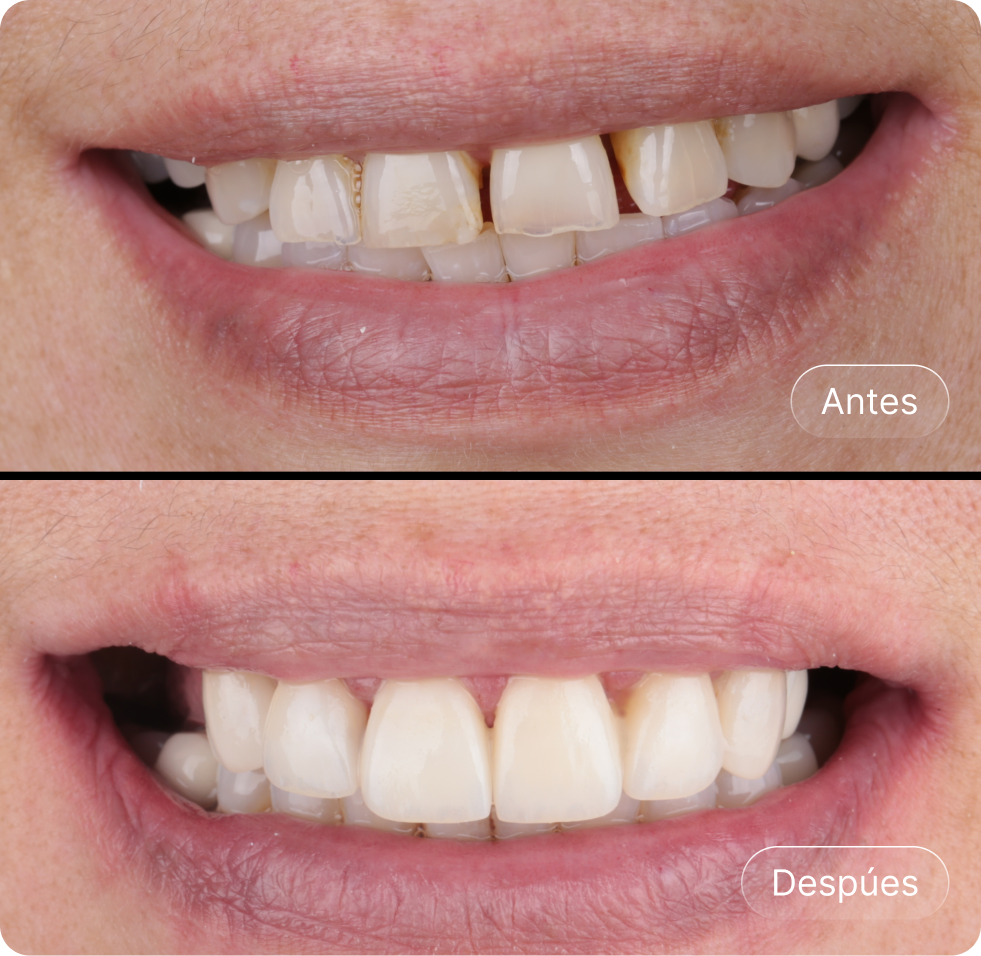 Imagen comparativa de dientes antes y después de un tratamiento dental, mostrando dientes manchados y desalineados en la parte superior y dientes más blancos y alineados en la parte inferior.