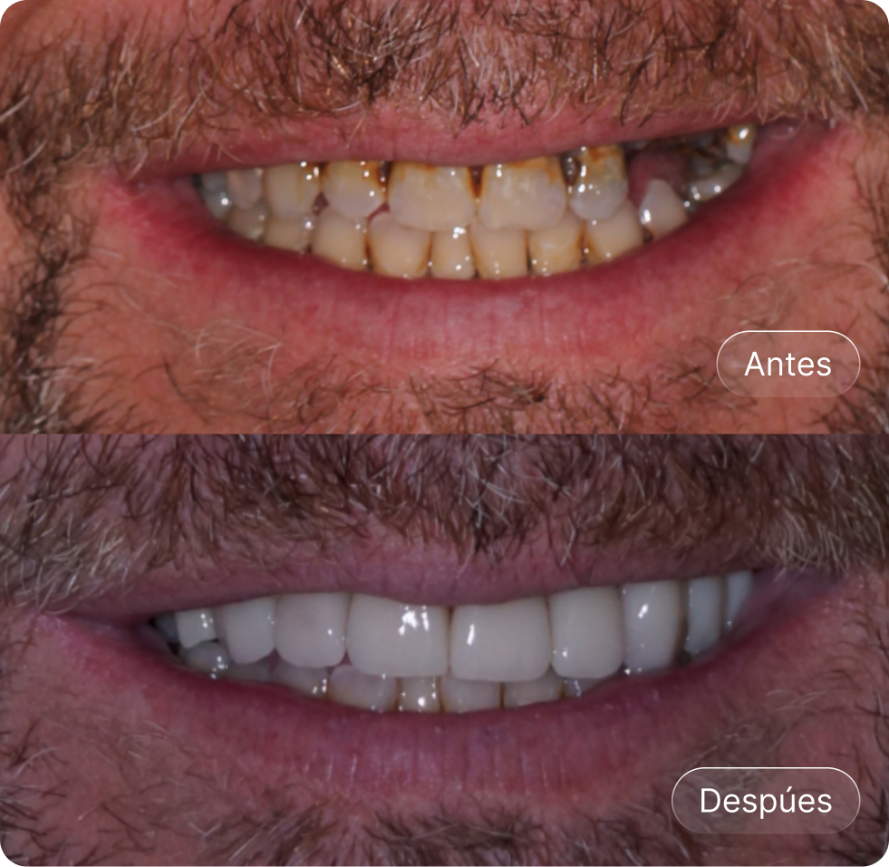 Comparación de sonrisa antes y después de blanqueamiento dental; dientes manchados y amarillentos en la imagen superior, dientes blancos y limpios en la imagen inferior.