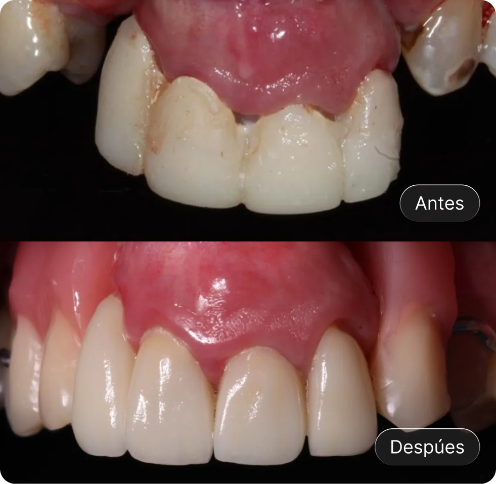 Imagen comparativa mostrando dientes anteriores con daño y manchas antes, y restaurados y limpios después.